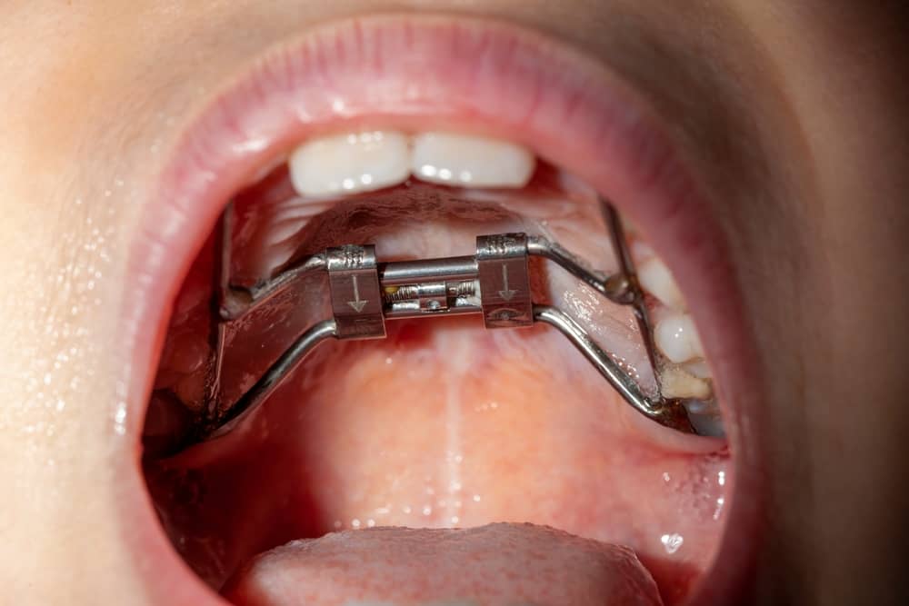 Is Invisalign Better Than Braces?, Dental Salon