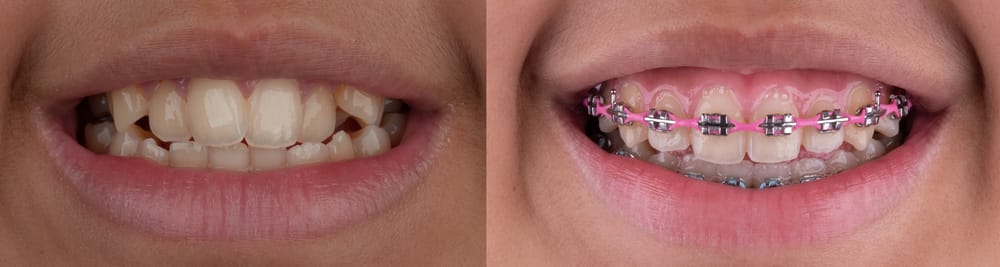 A side-by-side before-and-after comparison featuring crooked teeth before braces and in braces.