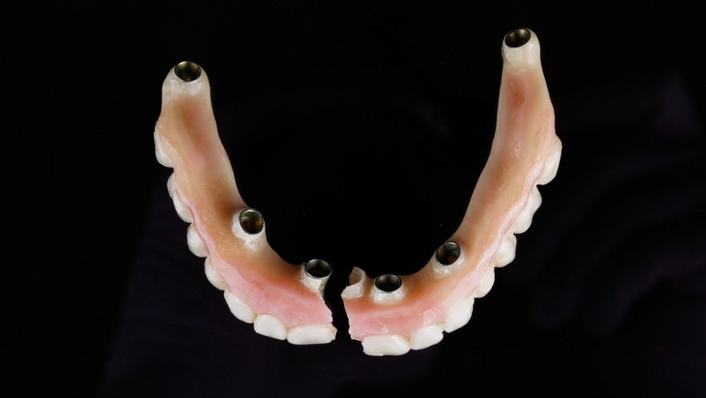 A fractured fixed implant denture prosthesis
