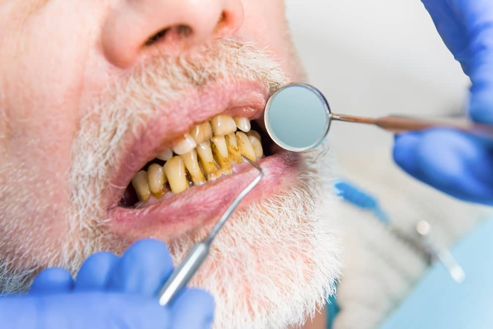 A dentist examines a patient with gum disease, stained teeth, and signs of smoking