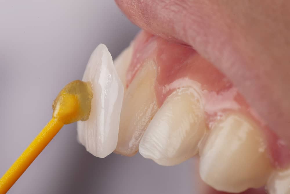 Dental veneer being placed on a prepped tooth