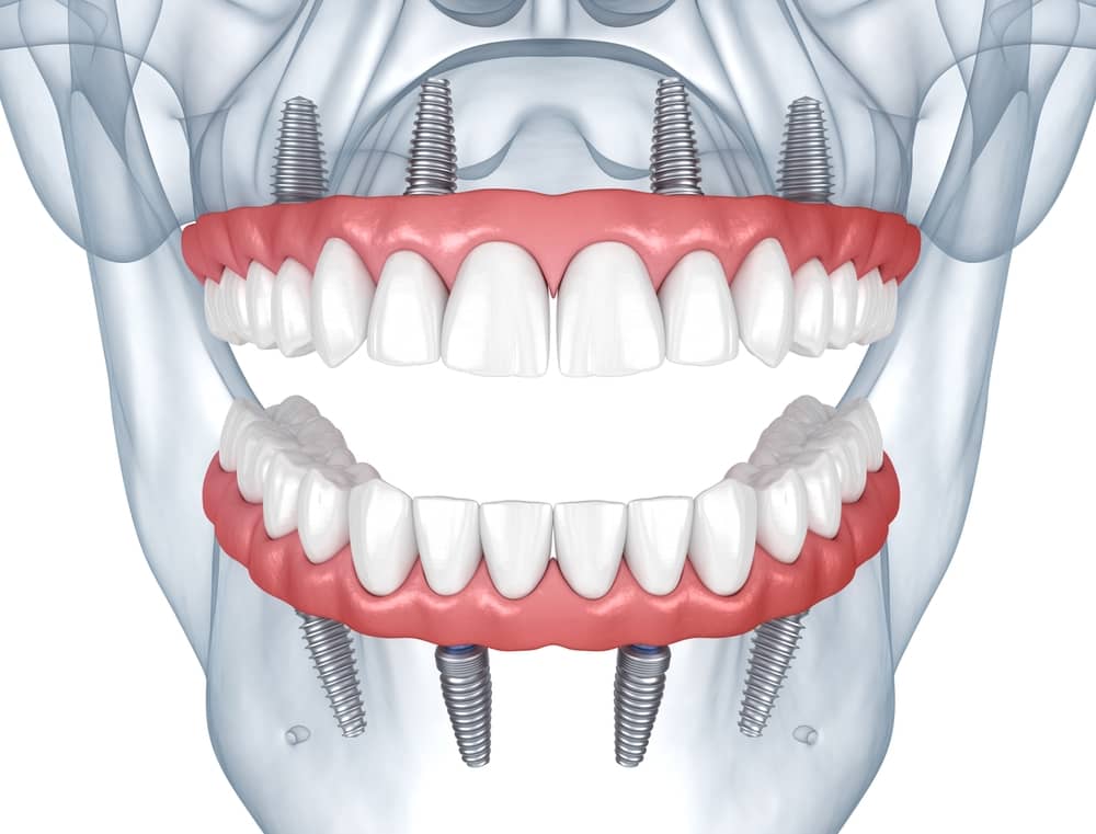 All-on-4 3D rendering upper and lower fixed implant dentures