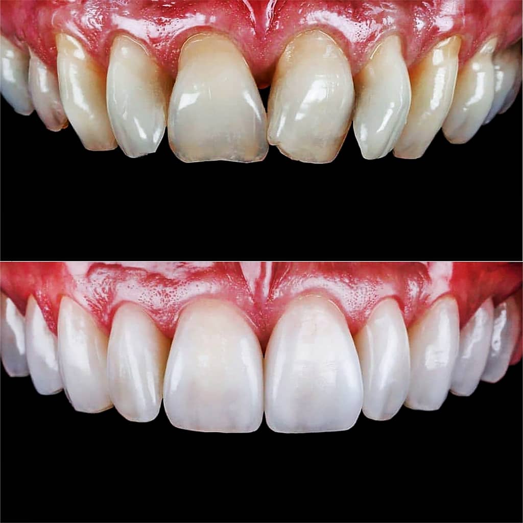 Before and After Cosmetic - Smile Science - Glendale, AZ