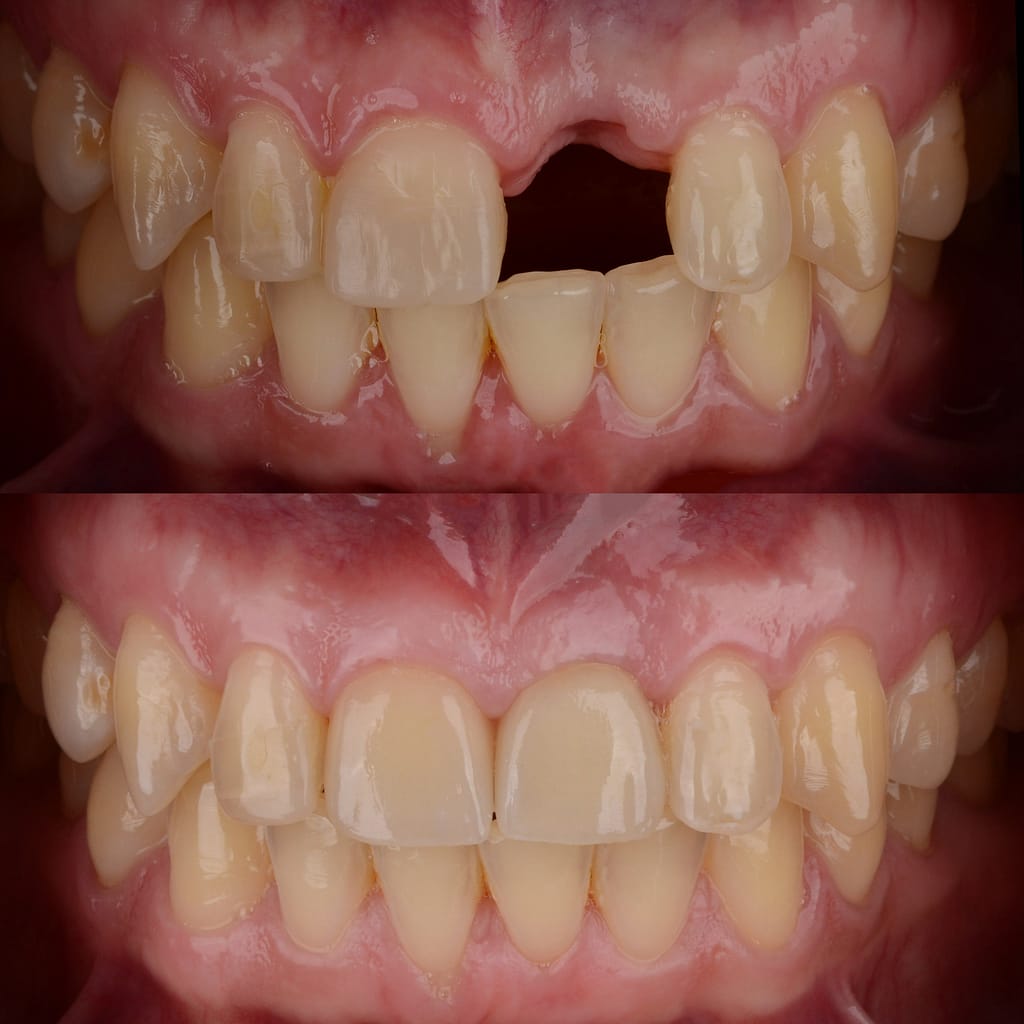 Ceramic Dental Bridge Before and After - Smile Science - Glendale, AZ
