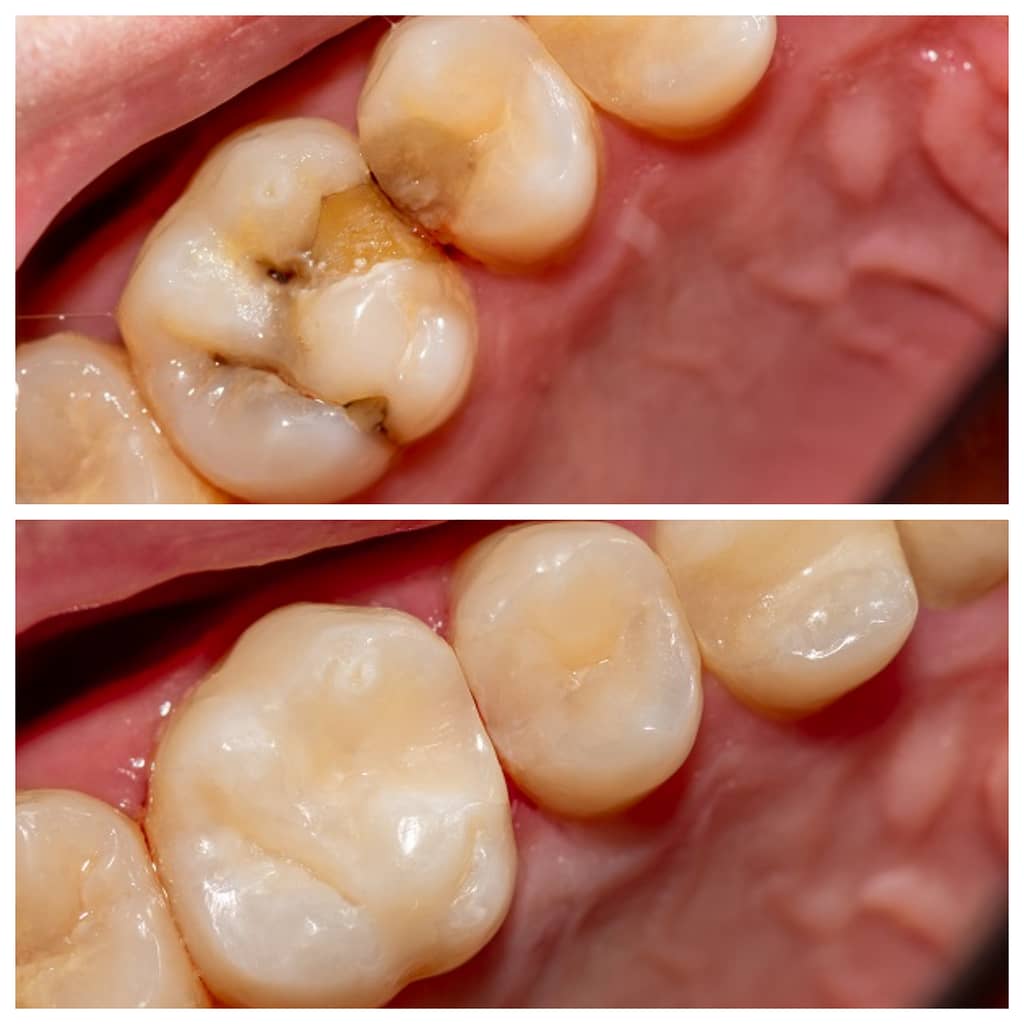 A dental filling before and after showing the replacement of an old filling with a new one