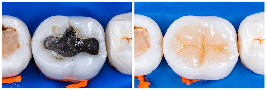 A side-by-side before-and-after showing replacement of an old amalgam filling with a composite resin filling