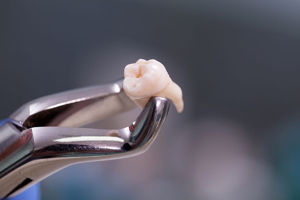 Tooth extraction with dental forceps.