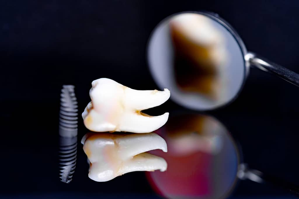 Dental Implant and Extracted Tooth - Glendale, AZ - Smile Science