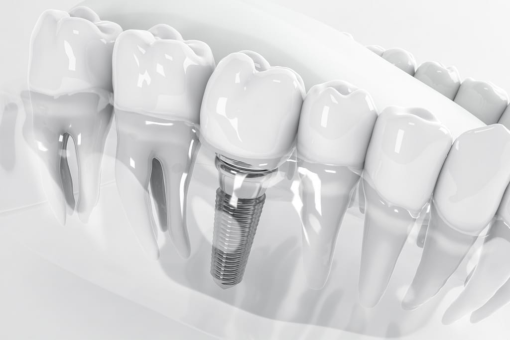 A 3D illustration of a dental implant in transparent gum and bone tissue
