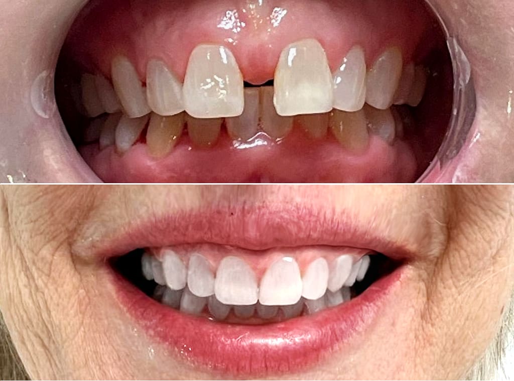 Our patient with diastema that affected her speech, before and after Invisalign treatment. Smile Science Dental Spa - Glendale, AZ