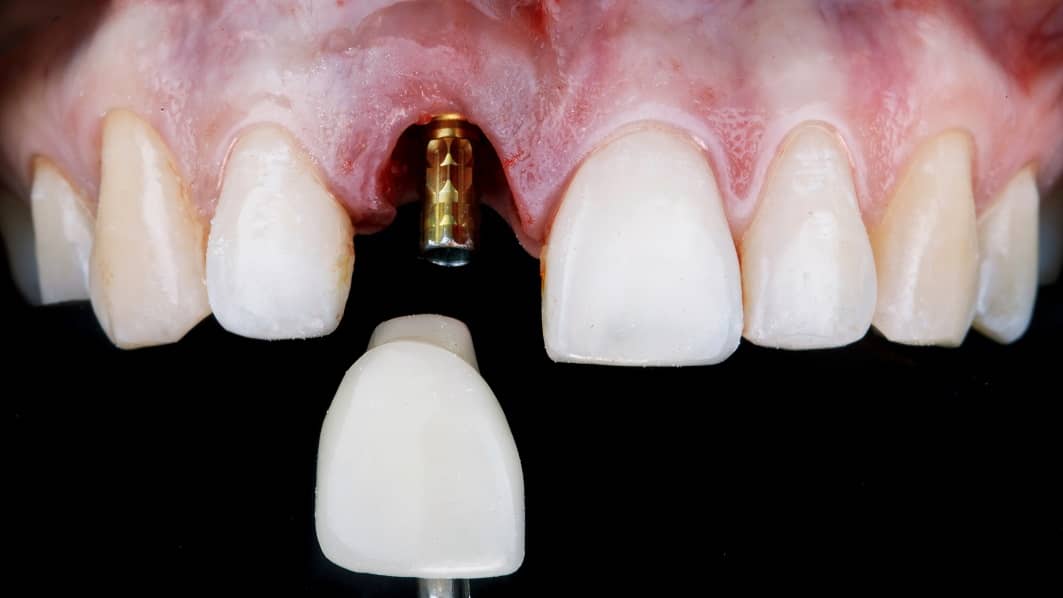 An implant crown being seated onto a dental implant abutment on a front central incisor.