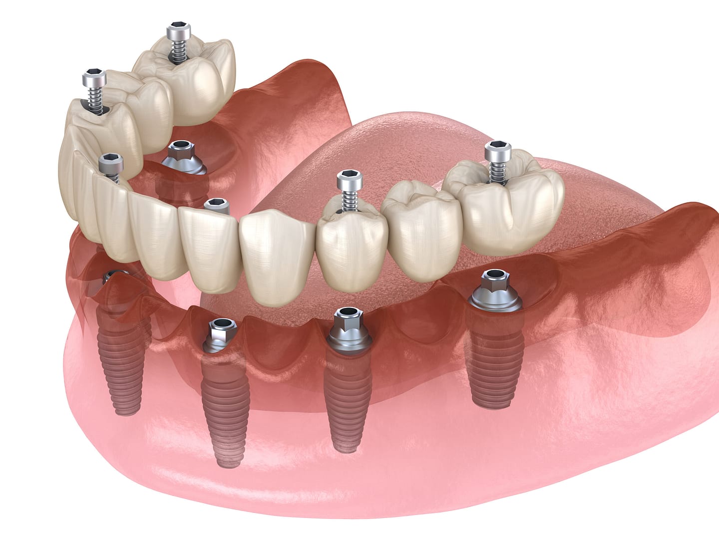 Fixed Implant Denture - Smile Science - Glendale, AZ