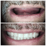 Dentures Before and After - Smile Science Dental Spa - Glendale, AZ