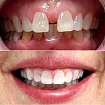Our patient with diastema that affected her speech, before and after Invisalign treatment. Smile Science Dental Spa - Glendale, AZ