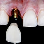 An implant crown being seated onto a dental implant abutment on a front central incisor.