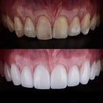 Cosmetic Veneers Before and After - Smile Science - Glendale, AZ