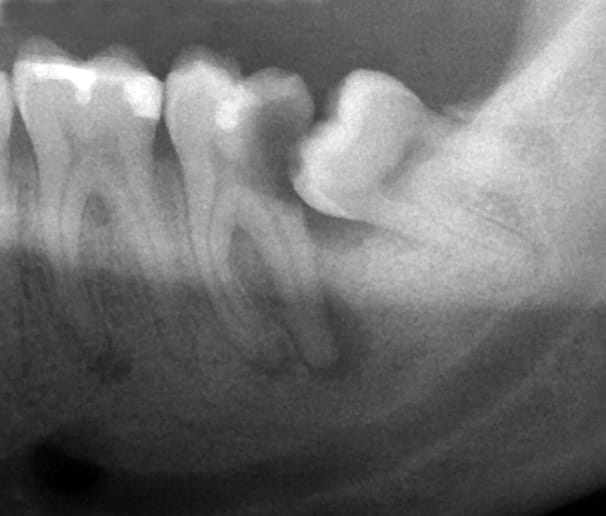Wisdom Tooth Massive Decay - Glendale, AZ - Smile Science