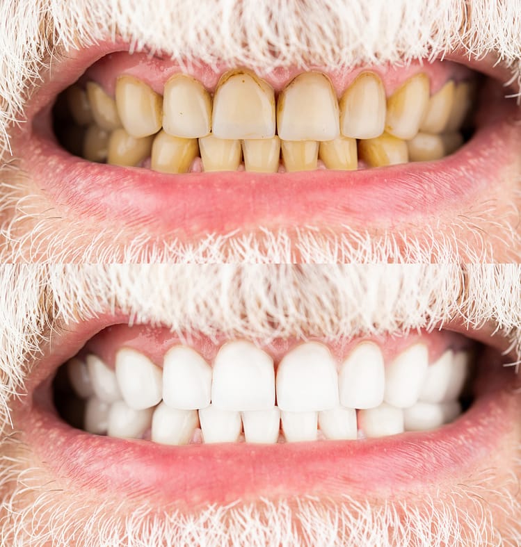 Teeth Whitening Before and After - Glendale, AZ - Smile Science