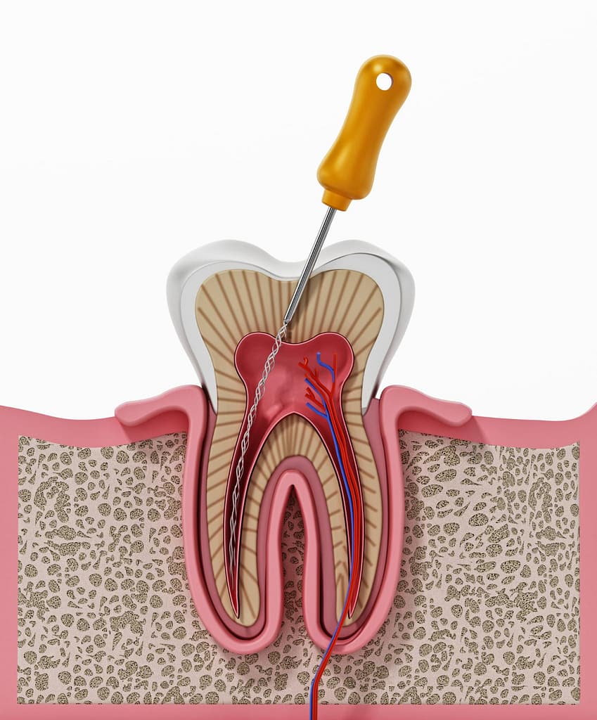 A graphical representation of a dental file inside the canal of a tooth