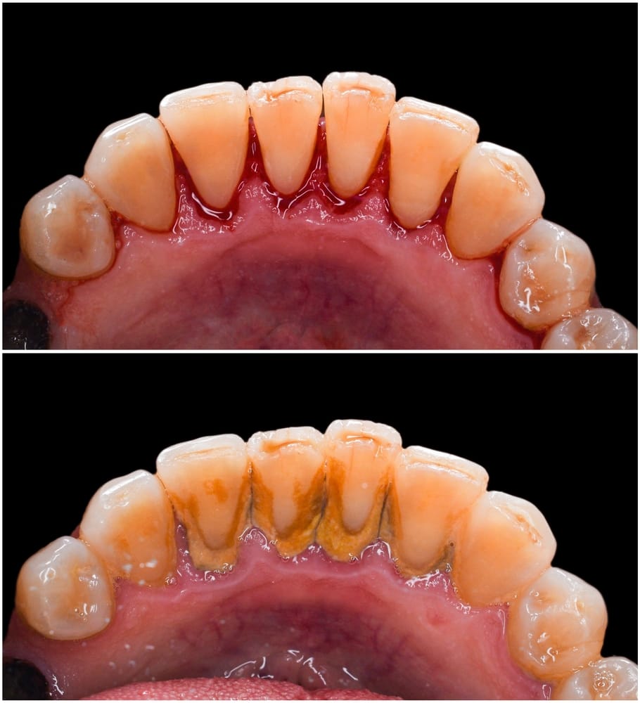 Deep Dental Cleaning Before and After